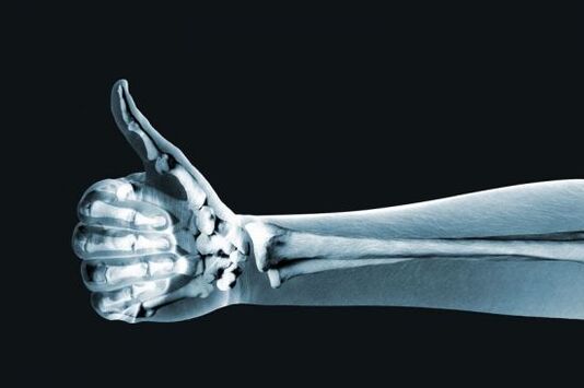 X-ray untuk mendiagnosis nyeri pada persendian jari