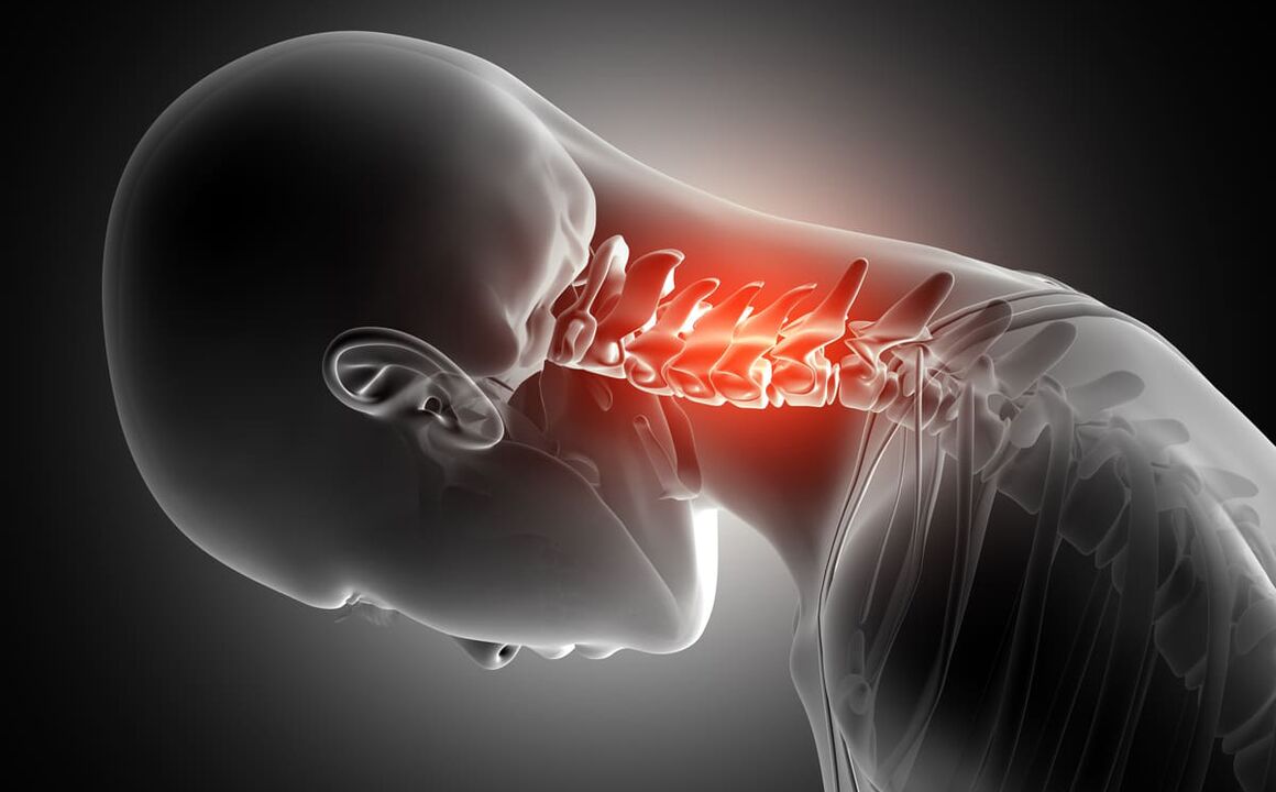 Osteochondrosis tulang belakang leher