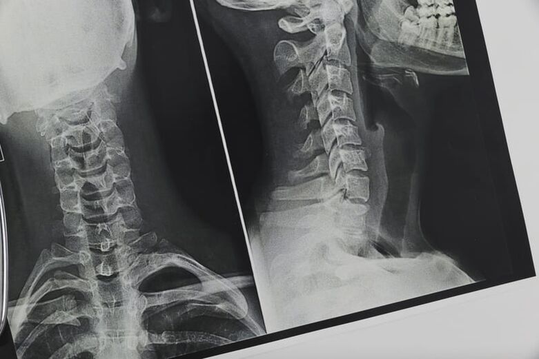X-ray tulang belakang leher yang terkena osteochondrosis
