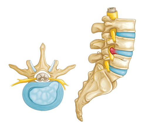 sakit punggung karena hernia intervertebralis