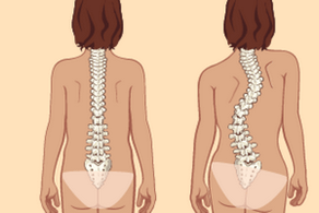 postur tegak dan skoliosis dengan osteochondrosis toraks