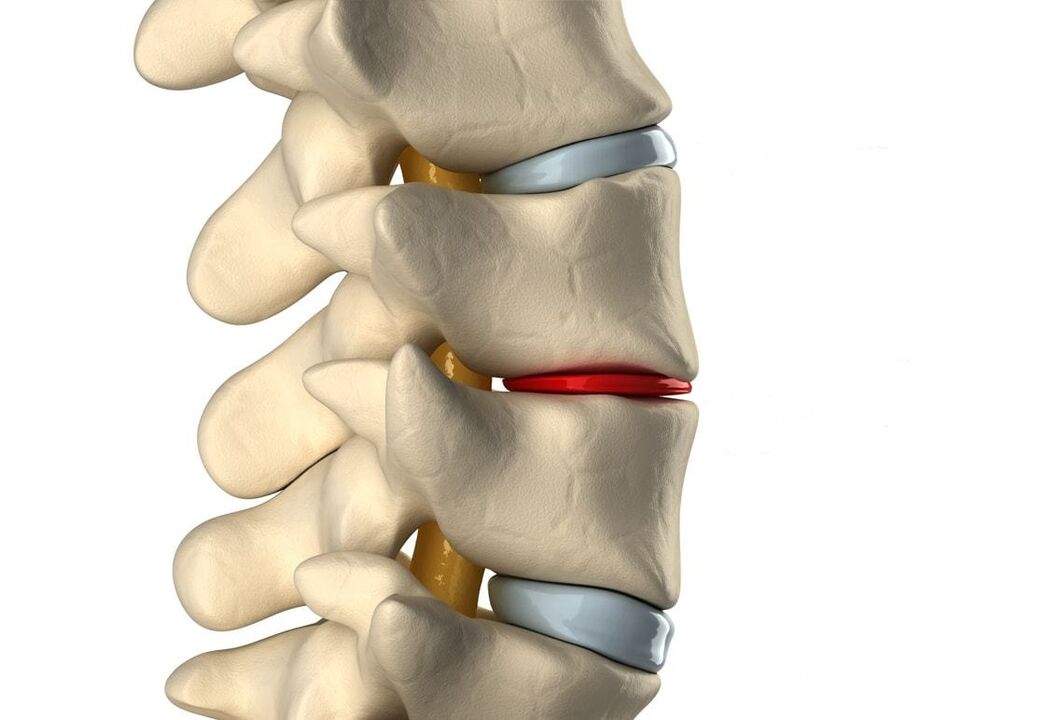 Diskus intervertebralis yang sehat (biru) dan rusak akibat osteochondrosis toraks (merah)
