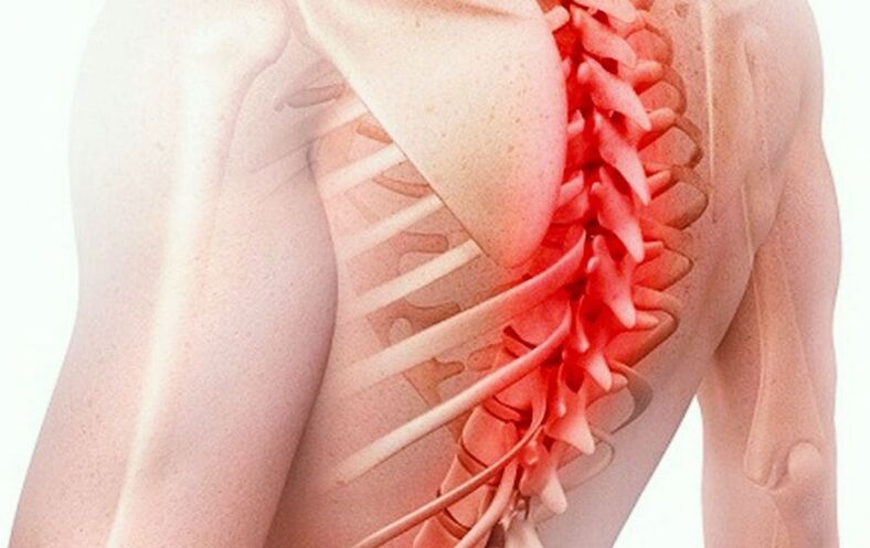 osteochondrosis tulang belakang dada