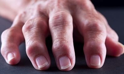 Apa perbedaan antara arthritis dari arthrosis