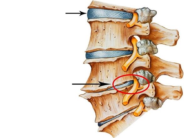 Gangguan pada cakram intervertebral