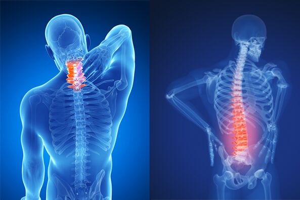 Osteochondrosis pada tulang belakang leher dan pinggang