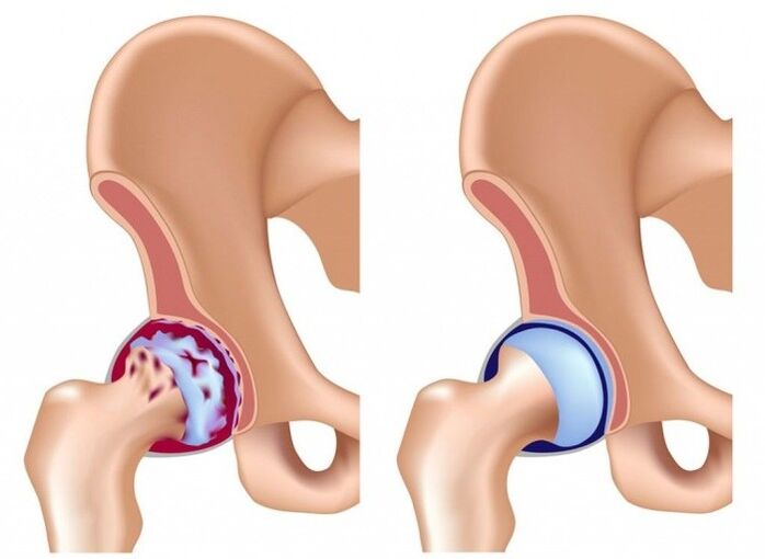 Kerusakan pada sendi panggul akibat arthrosis