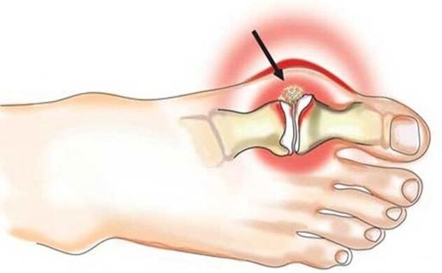 Peradangan pada sendi antara jempol kaki dan kaki akibat arthritis