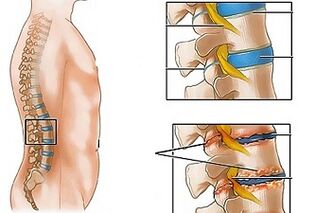 Penyebab osteochondrosis lumbar