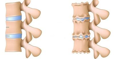 bagaimana mengenali keberadaan osteochondrosis lumbar