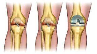 artroplasti untuk artrosis pada sendi lutut