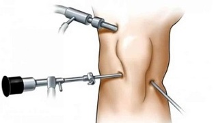 artroskopi untuk arthrosis sendi lutut